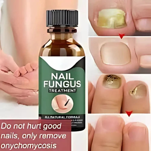 Nail Fungus Treatment -Advanced Antifungal Treatment