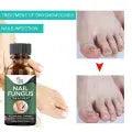 Nail Fungus Treatment -Advanced Antifungal Treatment